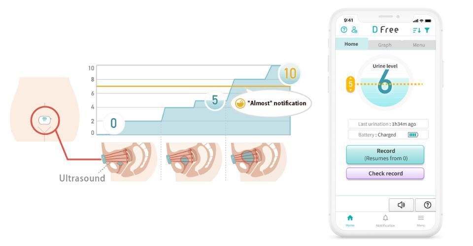 An image showing how the DFree device uses ultrasonic sensors to monitor the bladder, and an example of a smartphone notification